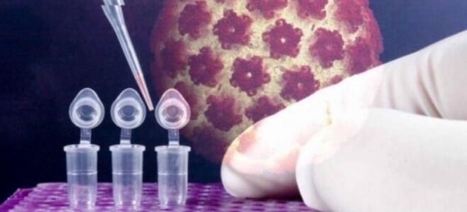 HPV-Diagnostik mit dem Digene-Test